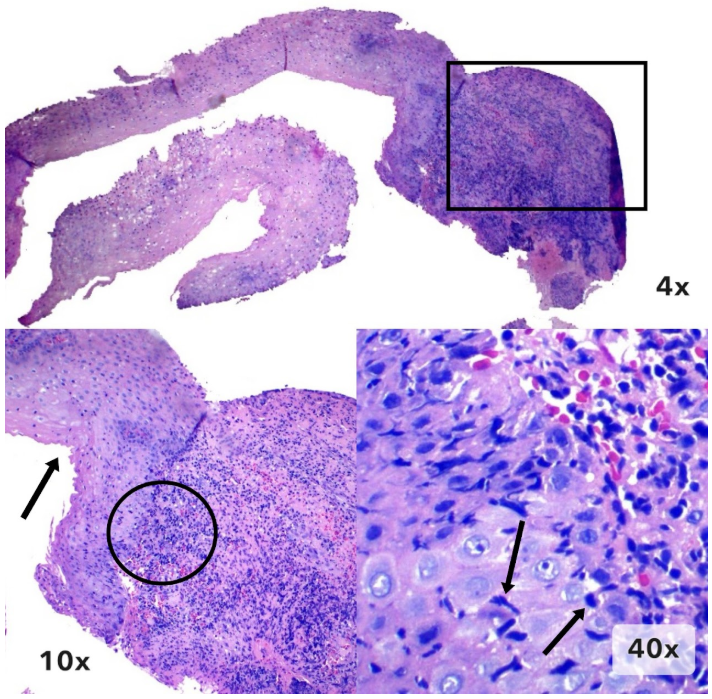 Esofagitis medicamentosa - Tejido de granulación
