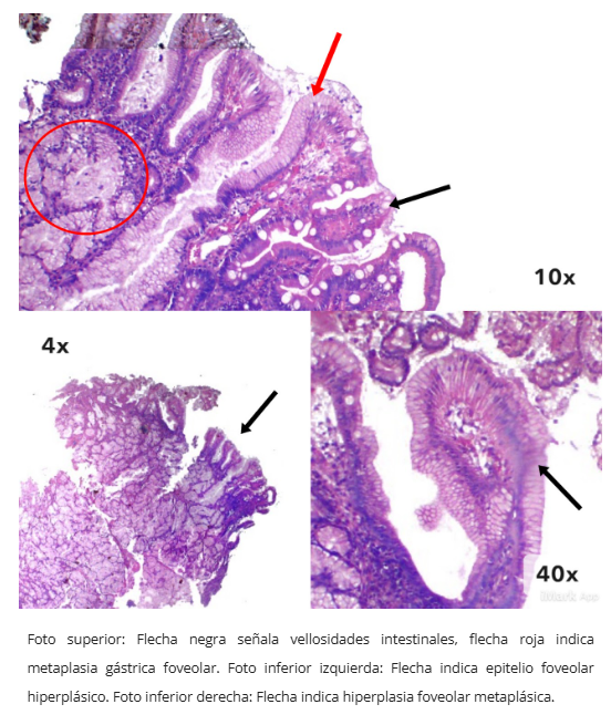 Pólipo inflamatorio