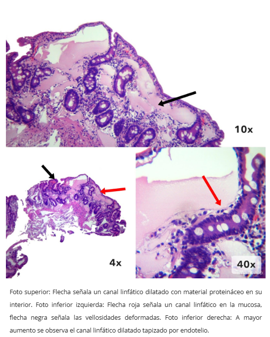 Linfagiectasia duodenal