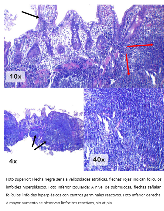 Hiperplasia linfoide nodular