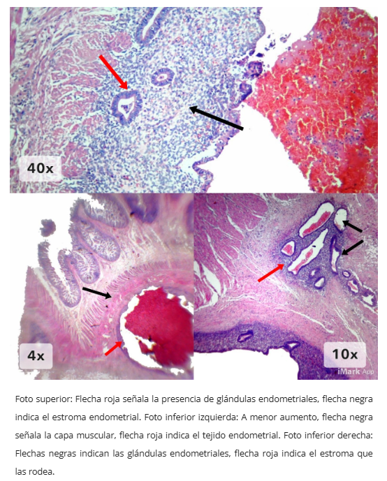 Endometriosis intestinal