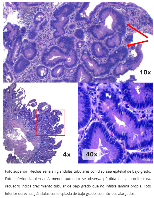 Adenoma ampular endoscópico
