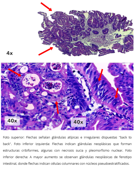 Adenocarcinoma ampular endoscópico