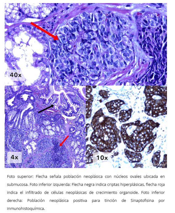 Neoplasia neuroendocrina