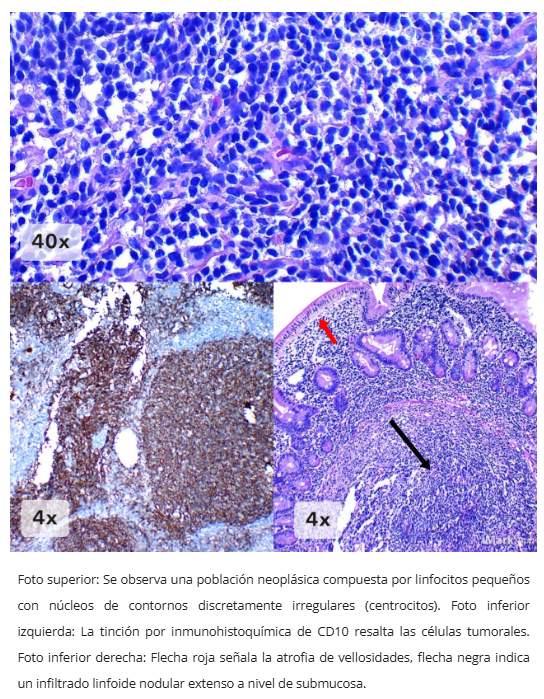 Linfoma folicular duodenal