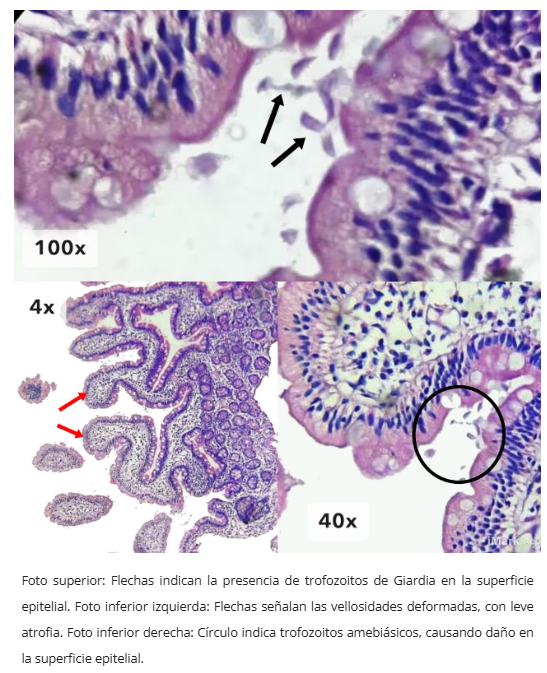 Gastropatía Reactiva