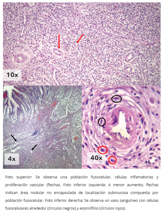Endoscopía de Pólipo Fibroide Inflamatorio