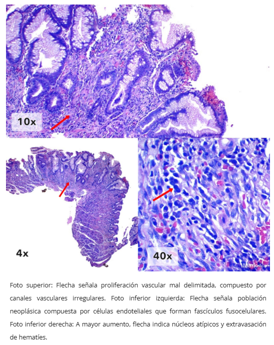 Sarcoma de Kaposi