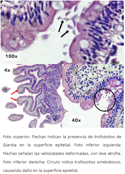 Giardiasis duodenal