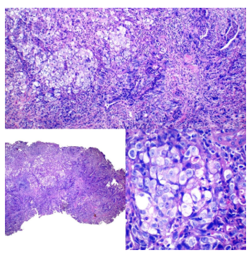 Adenocarcinoma sólido pobremente diferenciado