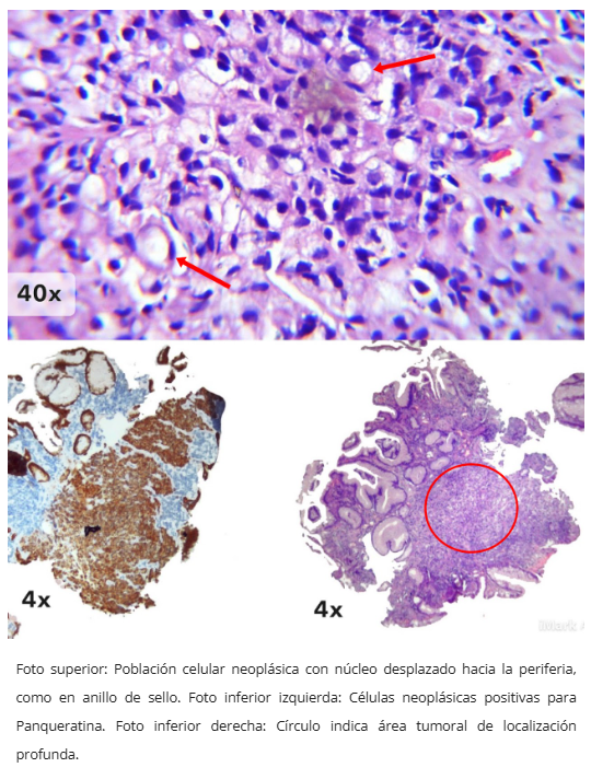 Carcinoma poco cohesivo