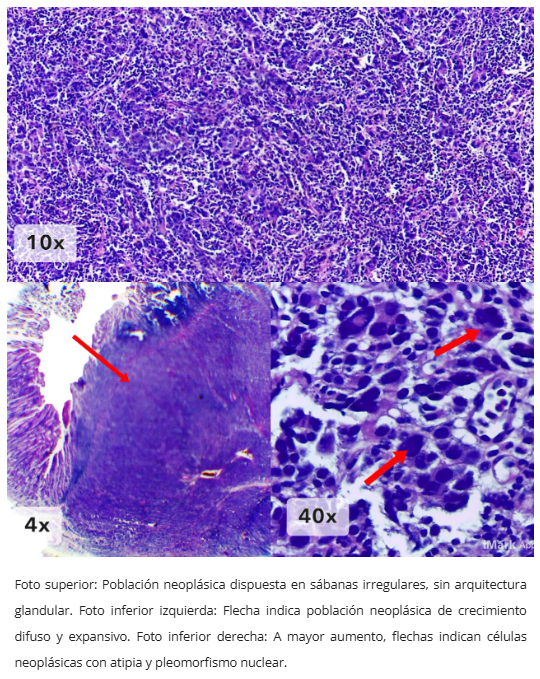 Carcinoma medular