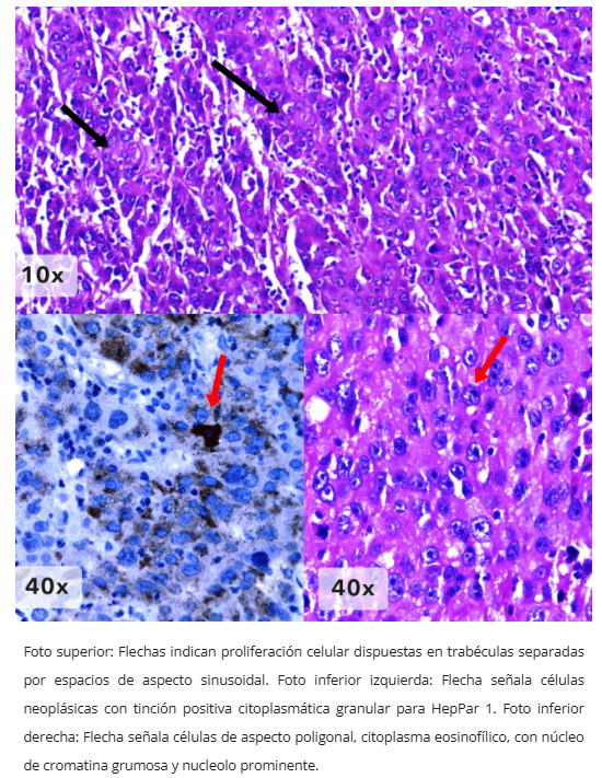 Adenocarcinoma hepatoide