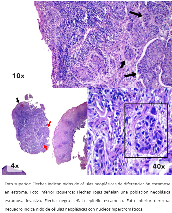 Imagen 1 de carcinoma escamoso
