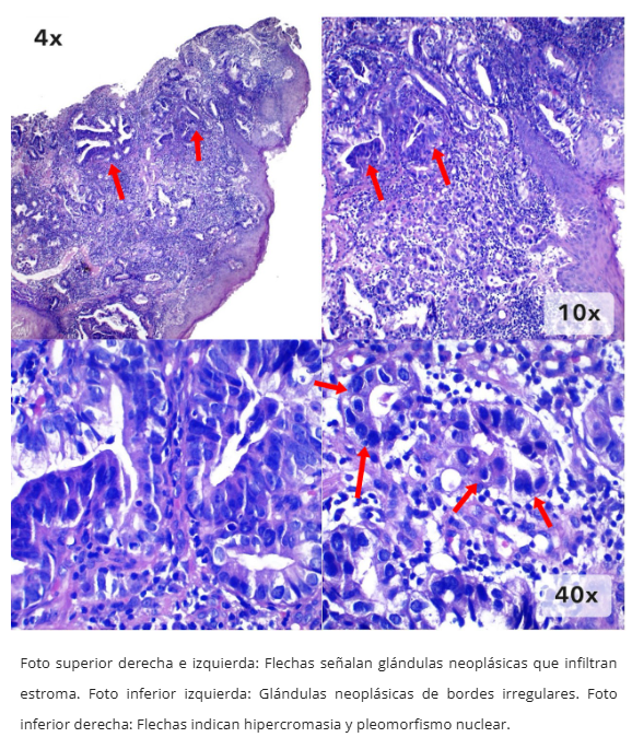 Imagen 1 de adenocarcinoma esofágico