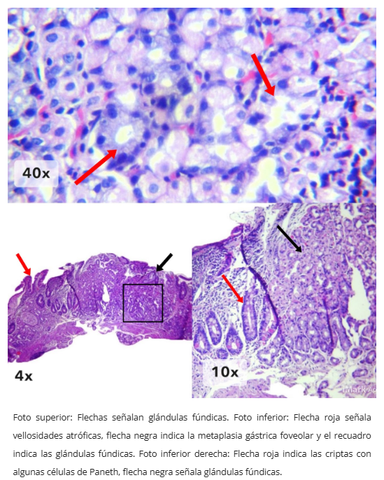 Mucosa gástrica heterotópica