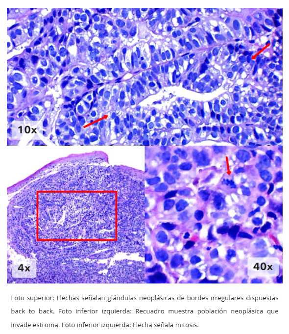 Imagen 10 de adenocarcinoma esofágico