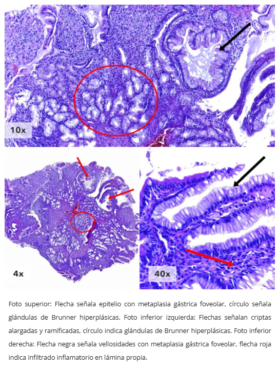 Pólipo inflamatorio