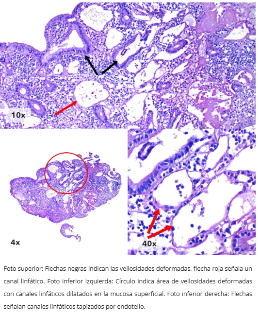 Linfagiectasia duodenal