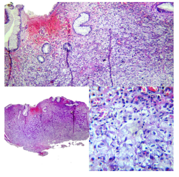 Diferenciación glandular focal