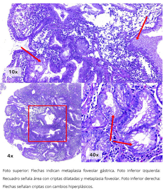 Pólipo inflamatorio