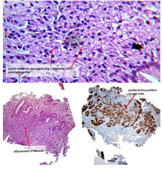Patrón trabecular
