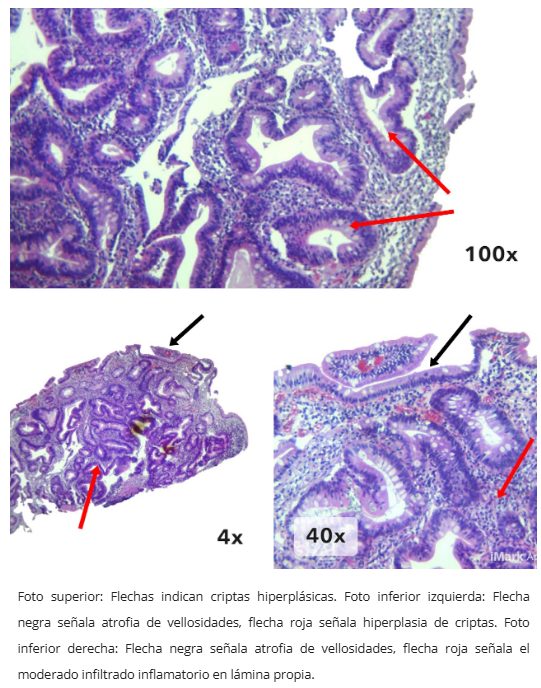 Pólipo inflamatorio