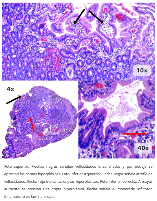 Pólipo inflamatorio