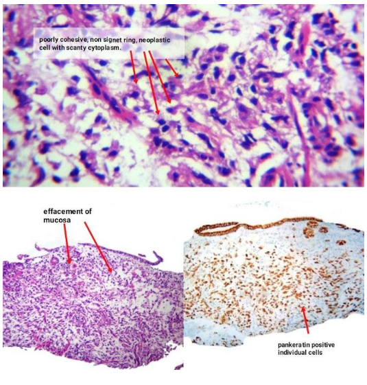 Endoscopía temprana