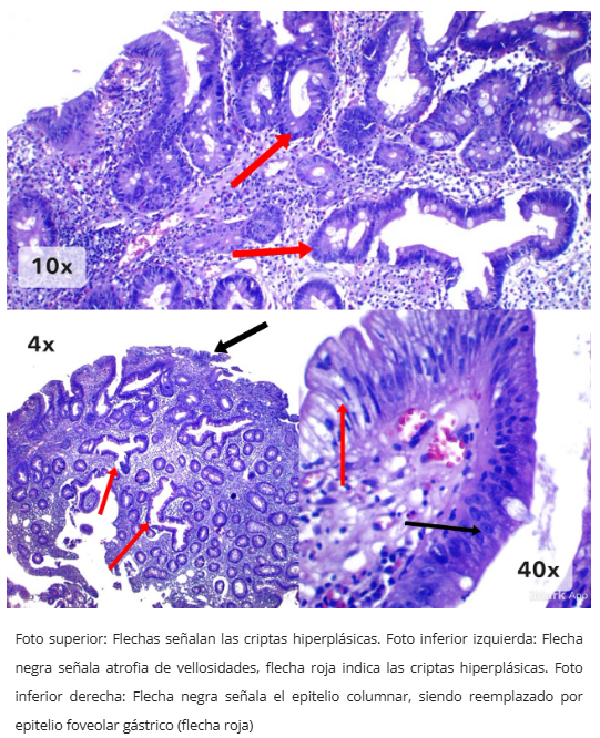 Pólipo inflamatorio