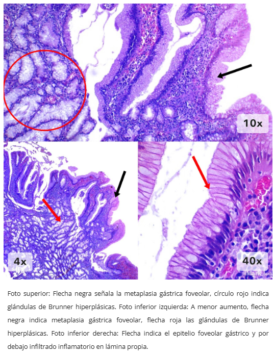 Pólipo inflamatorio