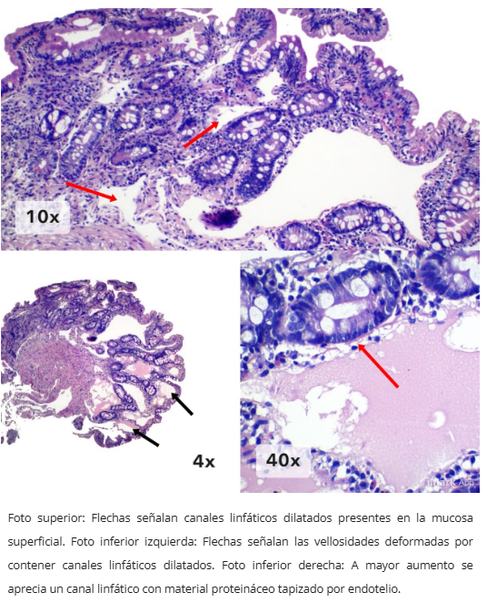 Linfagiectasia duodenal