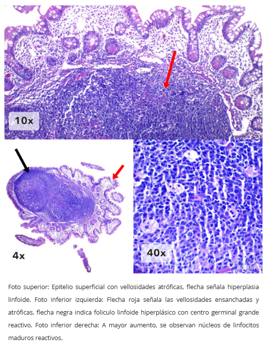 Hiperplasia linfoide nodular