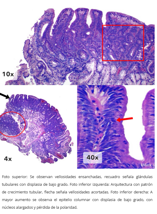 Adenoma tipo intestinal