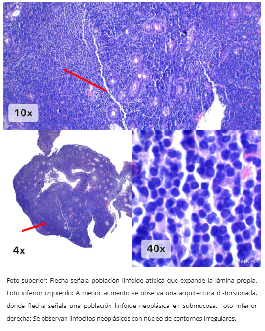 Inmunohistoquímica CD20
