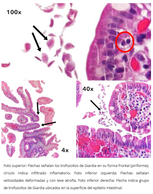 Gastropatía Reactiva