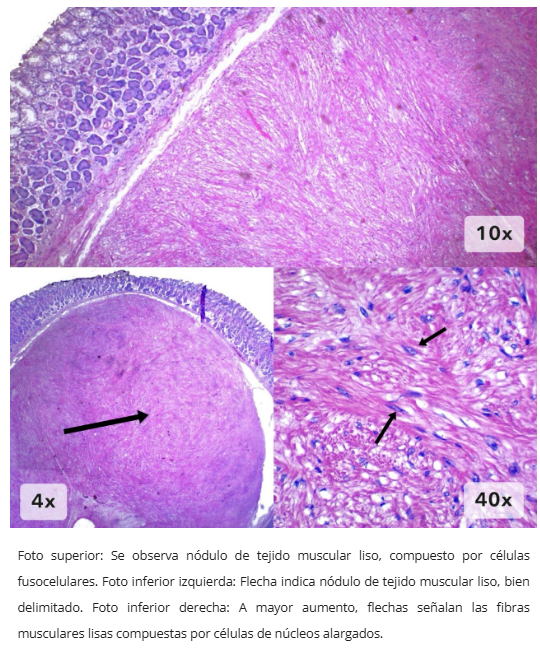 Lipoma endoscópico