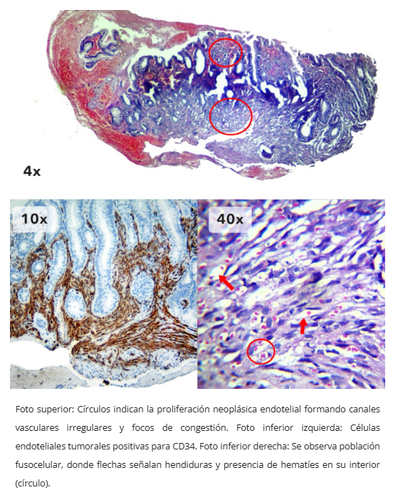 Sarcoma de Kaposi endoscópico