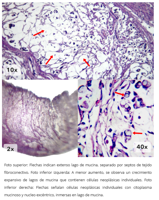 Patrón glandular