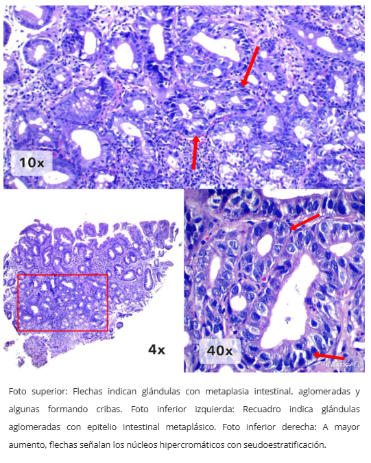 Metaplasia Intestinal Hiperproliferativa