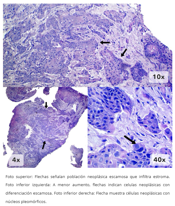 Imagen 2 de carcinoma escamoso