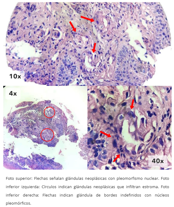 Imagen 2 de adenocarcinoma esofágico