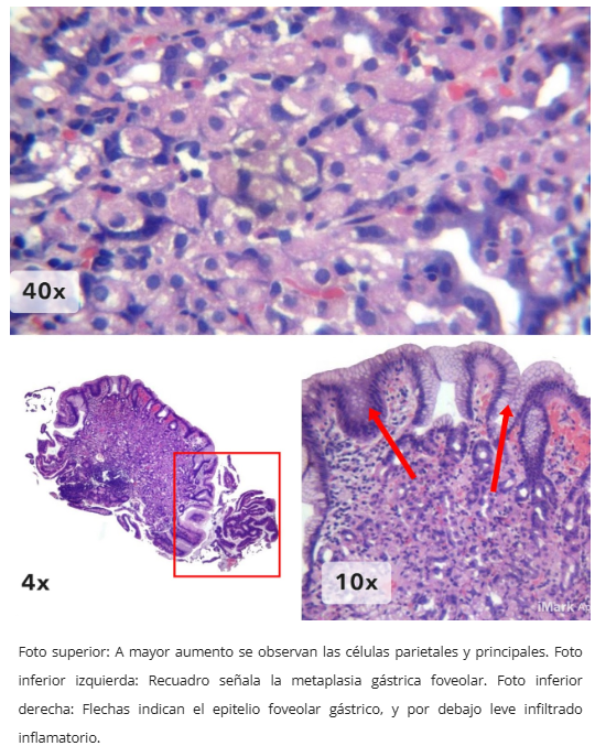 Mucosa gástrica heterotópica