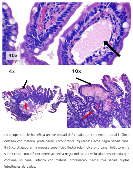 Linfagiectasia duodenal
