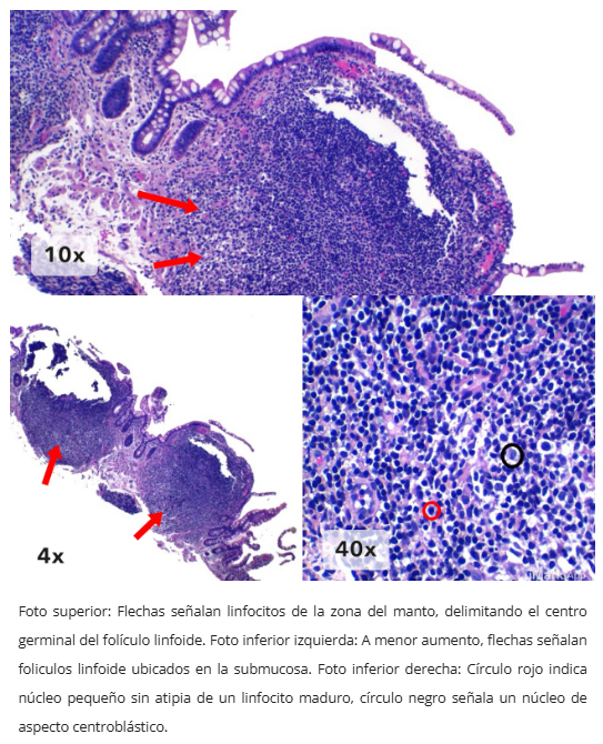 Hiperplasia linfoide nodular