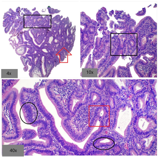 Adenoma gástrico