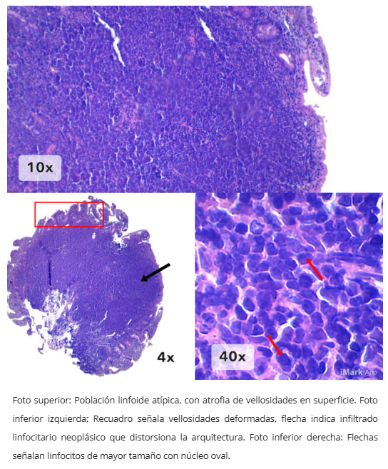 Inmunohistoquímica BCL2