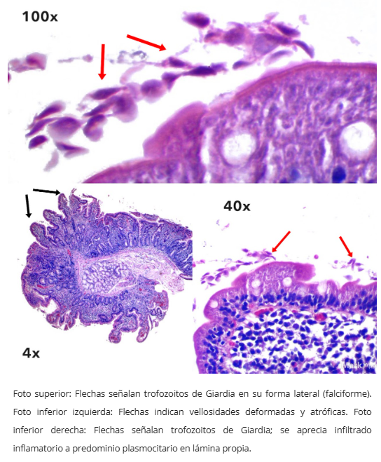Gastropatía Reactiva