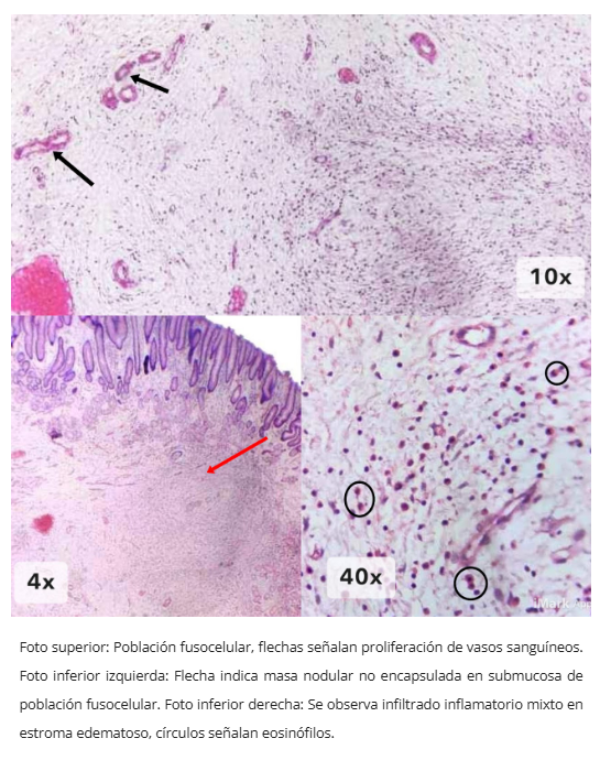 Infiltrado eosinofílico