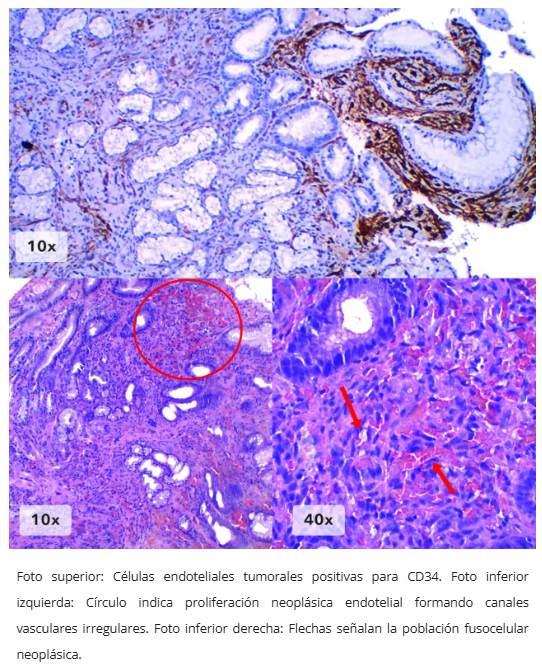 Inmunohistoquímica HHV8